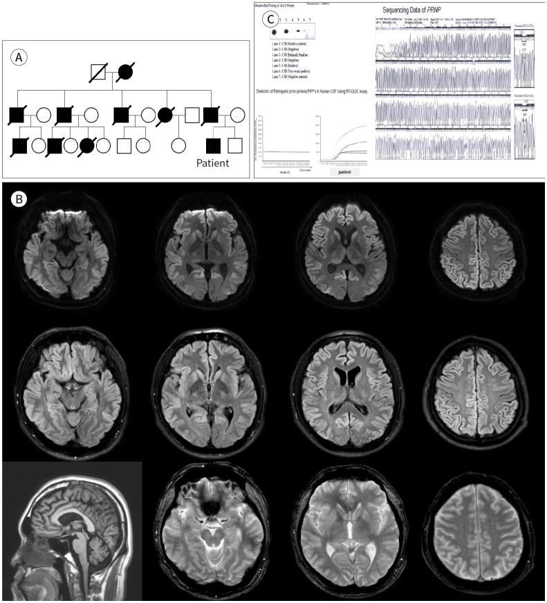 Gerstmann-Sträussler-Scheinker Disease: A Case Report.