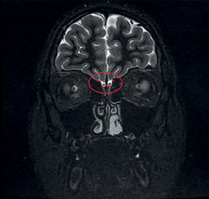 [Olfactory function and olfactory bulbs in patients with Kallmann syndrome].