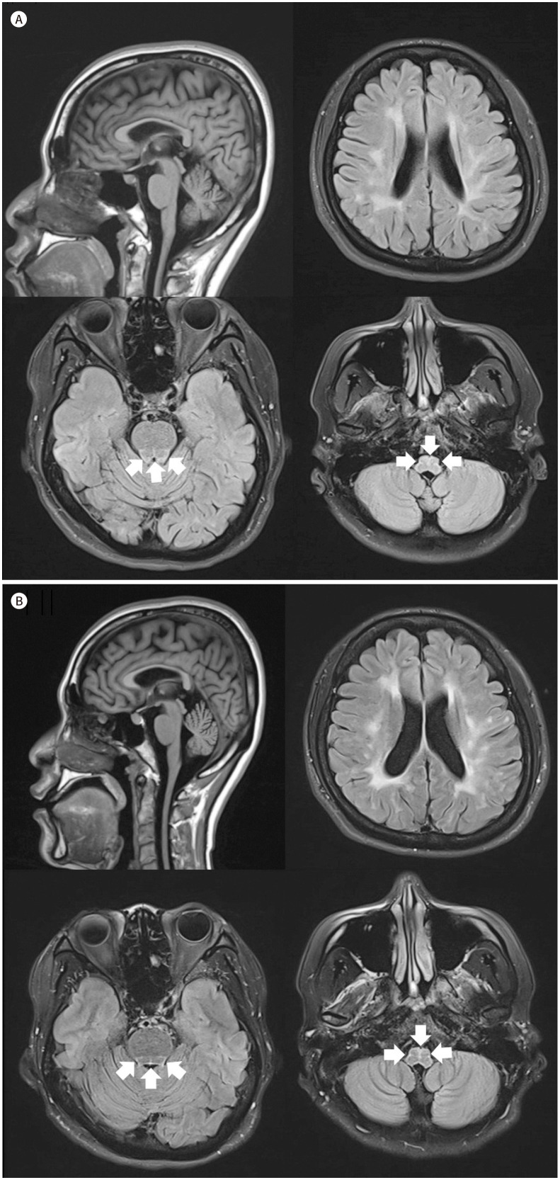 Characteristic MR Imaging Features and Serial Changes in Adult-Onset Alexander Disease: A Case Report.