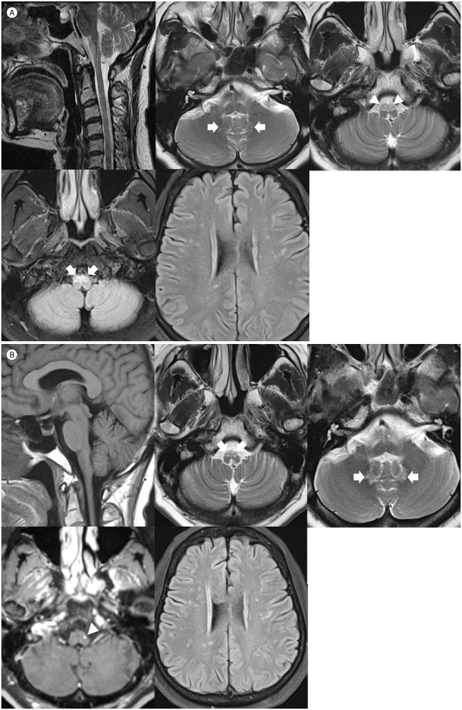 Characteristic MR Imaging Features and Serial Changes in Adult-Onset Alexander Disease: A Case Report.