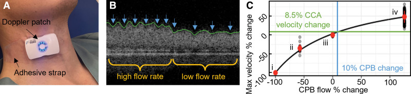 Detecting the Change in Total Circulatory Flow with a Wireless, Wearable Doppler Ultrasound Patch: A Pilot Study.