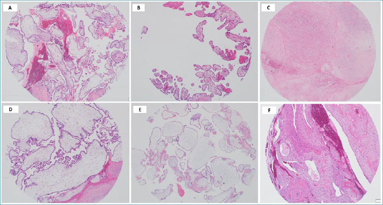 Immunohistochemical expression of BCL-2 in hydatidiform moles: a tissue microarray study.