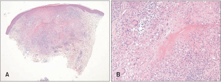 Successful Therapeutic Effect of 1,064-nm Nd:YAG Laser on Lupus Miliaris Disseminatus Faciei Solely on Neck.