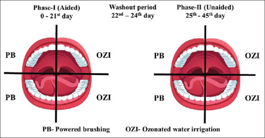 Effect of ozone irrigation and powered toothbrushing on dental plaque, gingival inflammation, and microbial status in institutionalized mentally challenged individuals: A double-blinded, randomized, controlled clinical trial.