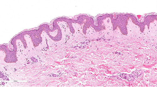 A unilateral linear pattern of lichen planus pigmentosus.