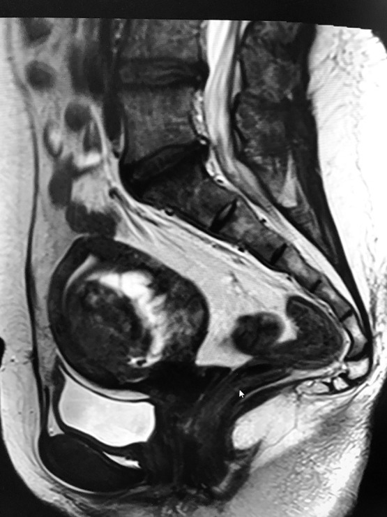 Rare recurrence of a multilocular cystic leiomyoma following myomectomy.