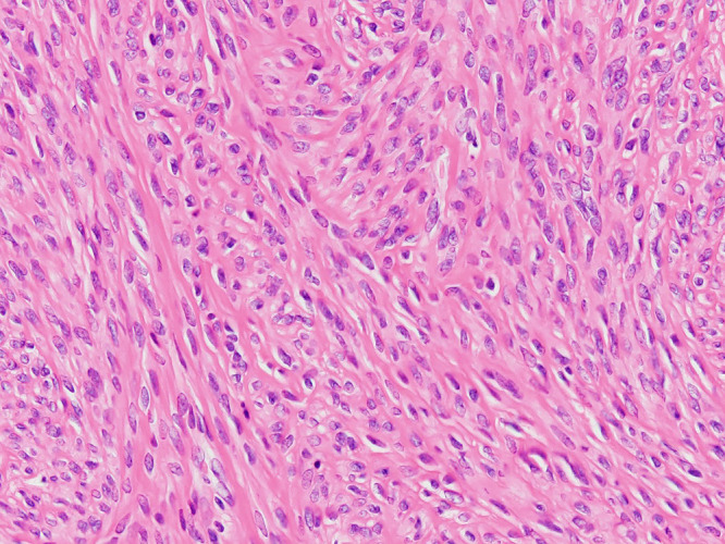 Rare recurrence of a multilocular cystic leiomyoma following myomectomy.