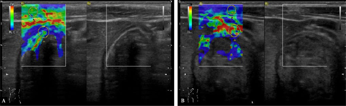 The usefulness of transabdominal ultrasound elastography in <i>Helicobacter pylori</i> gastritis in children.