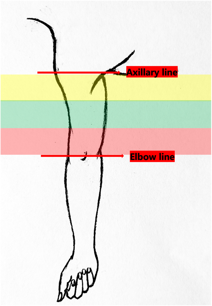 Expert consensus on the clinical application of totally implantable venous access devices in the upper arm (2022 Edition)