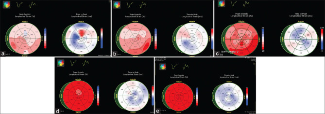 The utility of speckle-tracking echocardiography in early and midterm follow-up after anomalous origin of the left coronary artery from the pulmonary artery repair.