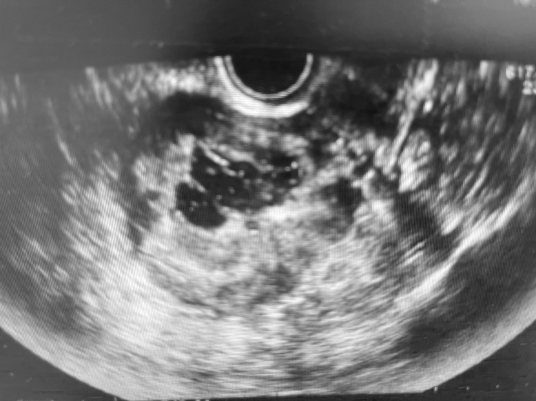 Rare recurrence of a multilocular cystic leiomyoma following myomectomy.