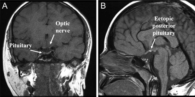 Abnormal thyroid function: an unusual presentation of pituitary stalk interruption syndrome.