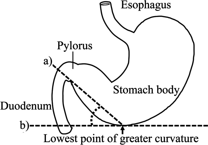 Stomach position evaluated using computed tomography is related to successful post-pyloric enteral feeding tube placement in critically ill patients: a retrospective observational study.