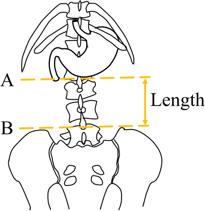 Stomach position evaluated using computed tomography is related to successful post-pyloric enteral feeding tube placement in critically ill patients: a retrospective observational study.