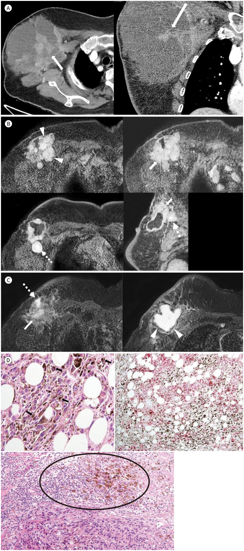 Primary Malignant Melanoma of the Breast Presenting as a Breast Abscess: A Case Report.