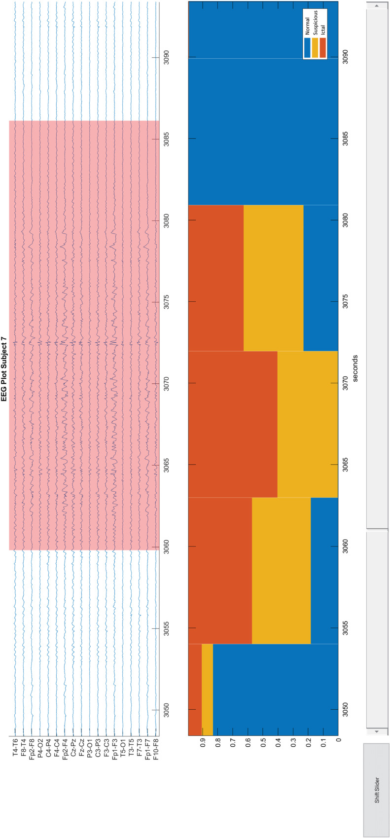 Pitfalls in EEG Analysis in Patients With Nonconvulsive Status Epilepticus: A Preliminary Study.