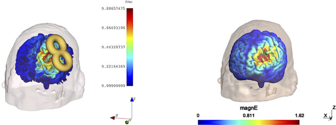 SlicerTMS: Real-Time Visualization of Transcranial Magnetic Stimulation for Mental Health Treatment.