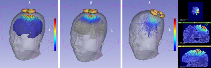 SlicerTMS: Real-Time Visualization of Transcranial Magnetic Stimulation for Mental Health Treatment.