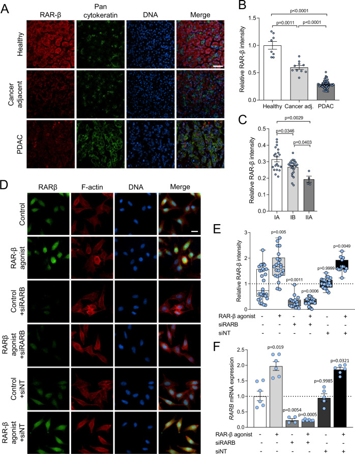 Retinoic acid receptor β modulates mechanosensing and invasion in pancreatic cancer cells via myosin light chain 2.