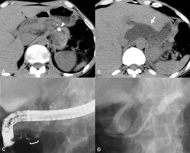 Large or multiple pseudocysts can impede or complicate the nonsurgical treatment of pancreatolithiasis.