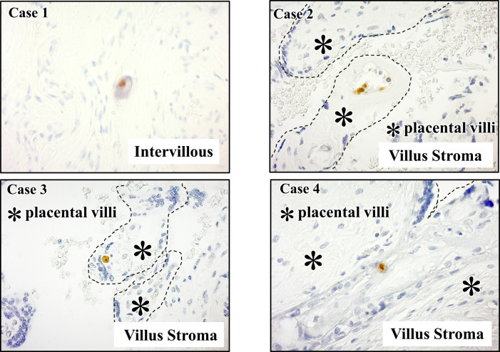 Retrospective immunohistochemical analysis of human cytomegalovirus infection in the placenta and its association with fetal growth restriction.