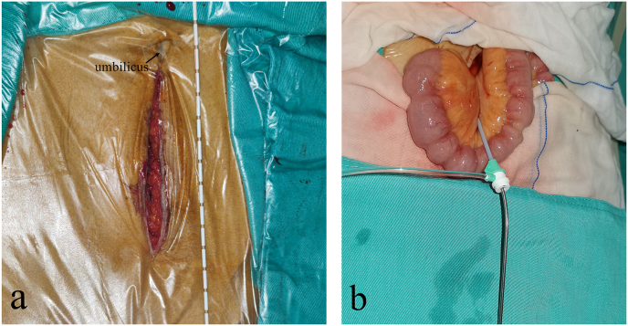 Application of transmesenteric vein extrahepatic portosystemic shunt in treatment of symptomatic portal hypertension with cavernous transformation of portal vein