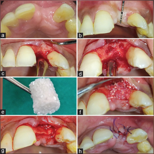 Synthetic mineral collagen composite bone graft with ribose cross linked collagen membrane for lateral ridge augmentation.