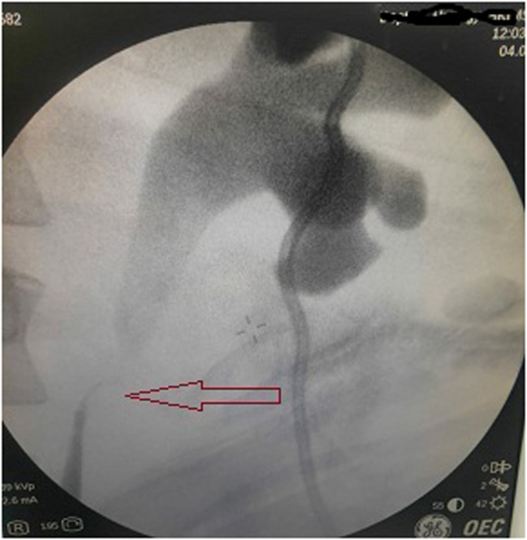 Incidence of Ureteric strictures Following Ureteroscopic Laser Lithotripsy: Holmium:YAG Versus Thulium Fiber Laser.