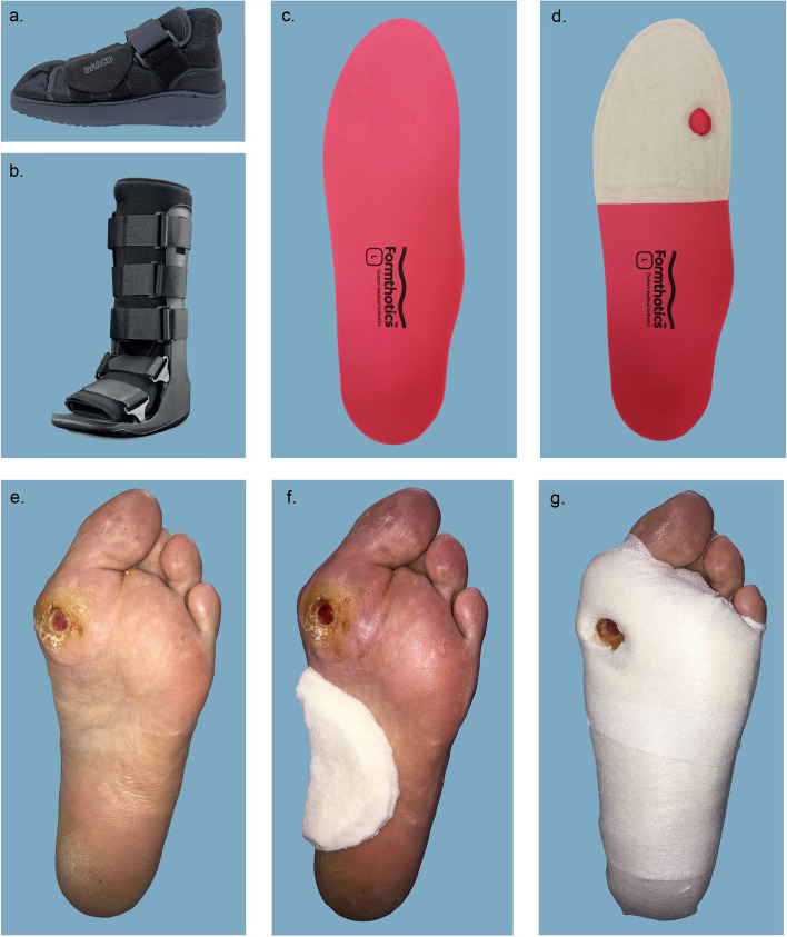 Offloading effects of a removable cast walker with and without modification for diabetes-related foot ulceration: a plantar pressure study.