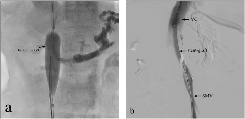 Application of transmesenteric vein extrahepatic portosystemic shunt in treatment of symptomatic portal hypertension with cavernous transformation of portal vein