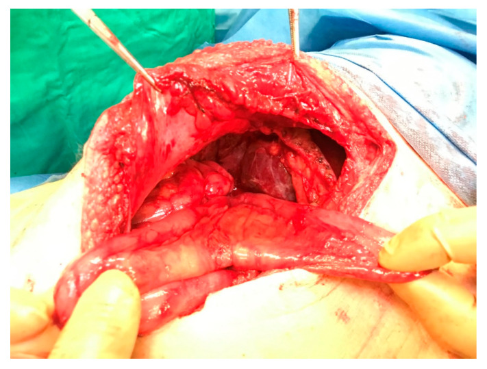 Averting an Unnecessary Revision of a Roux-en-Y Hepaticojejunostomy by Surgically Creating an Access Point for the Endoscopic Assessment of the Anastomosis: A Report of a Case.