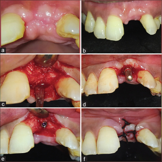 Synthetic mineral collagen composite bone graft with ribose cross linked collagen membrane for lateral ridge augmentation.