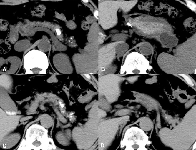 Large or multiple pseudocysts can impede or complicate the nonsurgical treatment of pancreatolithiasis.