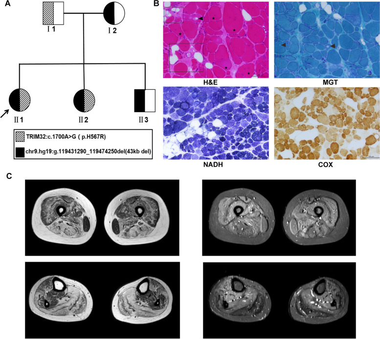 TRIM32 biallelic defects cause limb-girdle muscular dystrophy R8: identification of two novel mutations and investigation of genotype-phenotype correlation.