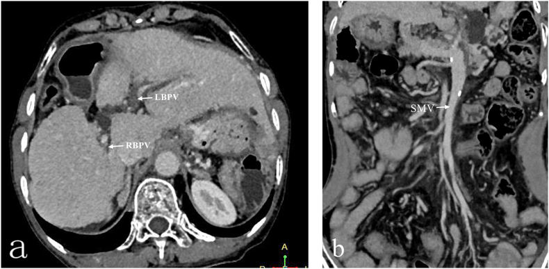 Application of transmesenteric vein extrahepatic portosystemic shunt in treatment of symptomatic portal hypertension with cavernous transformation of portal vein