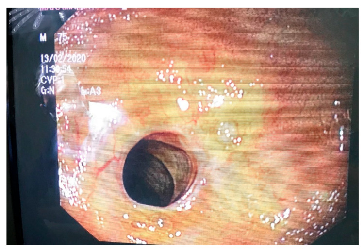 Averting an Unnecessary Revision of a Roux-en-Y Hepaticojejunostomy by Surgically Creating an Access Point for the Endoscopic Assessment of the Anastomosis: A Report of a Case.