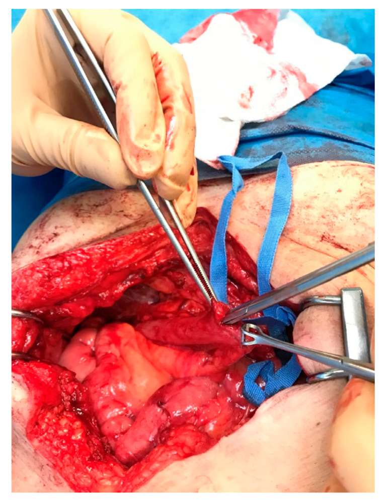 Averting an Unnecessary Revision of a Roux-en-Y Hepaticojejunostomy by Surgically Creating an Access Point for the Endoscopic Assessment of the Anastomosis: A Report of a Case.