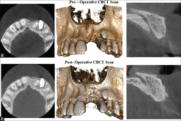 Synthetic mineral collagen composite bone graft with ribose cross linked collagen membrane for lateral ridge augmentation.