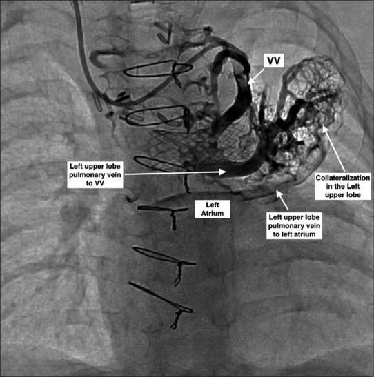 Partial anomalous venous connection with intrapulmonary dual drainage: Transcatheter treatment of a rare entity.