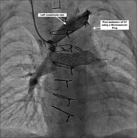 Partial anomalous venous connection with intrapulmonary dual drainage: Transcatheter treatment of a rare entity.