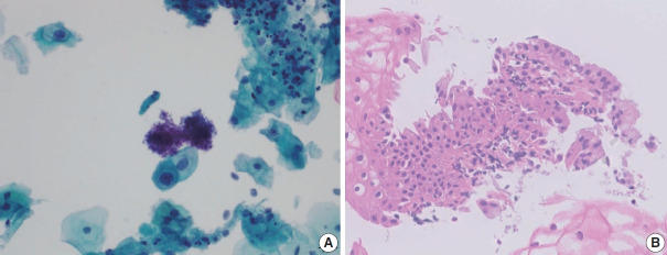 Trouble-makers in cytologic interpretation of the uterine cervix.