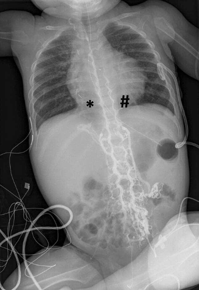 Inferior vena cava thrombosis-rope ladder sign.