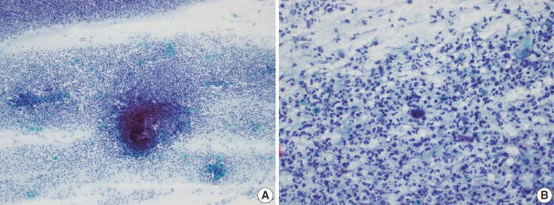 Trouble-makers in cytologic interpretation of the uterine cervix.