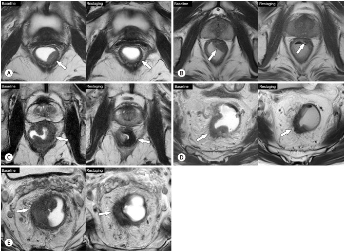 [Interpretation of Rectal MRI after Neoadjuvant Treatment in Patients with Rectal Cancer].