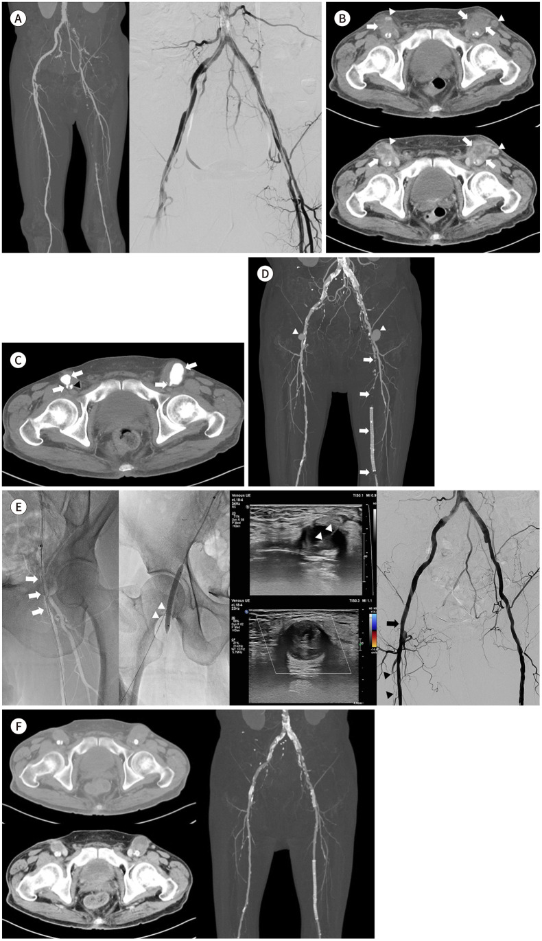 [Delayed Bilateral Common Femoral Pseudoaneurysm after Percutaneous Access with Interventional Management: A Case Report].