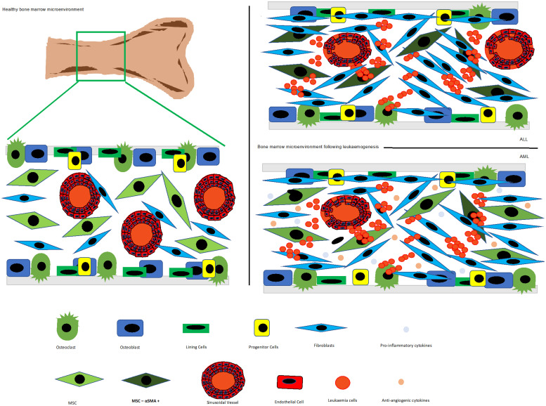 Targeting N-cadherin (CDH2) and the malignant bone marrow microenvironment in acute leukaemia.