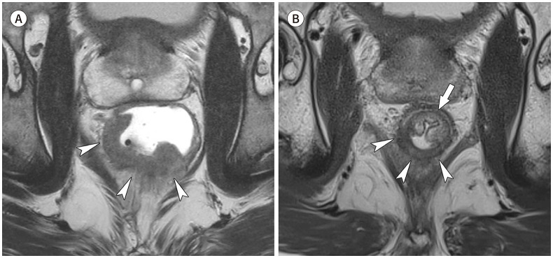 [Interpretation of Rectal MRI after Neoadjuvant Treatment in Patients with Rectal Cancer].