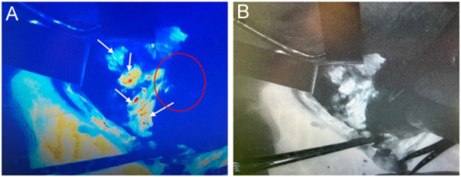 Silent intrathyroid parathyroid carcinoma.