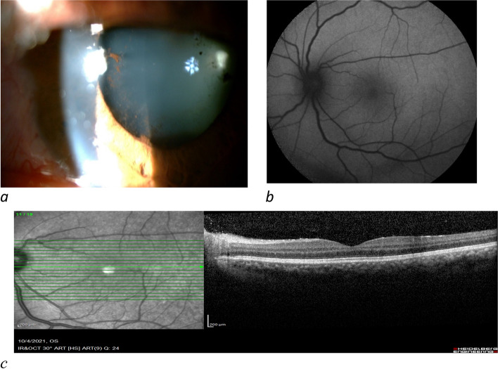 Uveitis including Vogt-Koyanagi-Harada syndrome following inactive covid-19 vaccination: a case series.