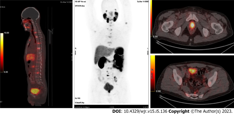 Future of prostate imaging: Artificial intelligence in assessing prostatic magnetic resonance imaging.